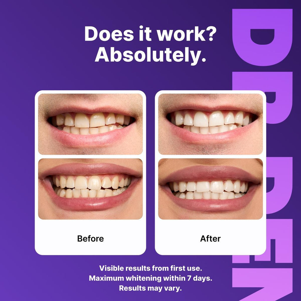 Purple Whitening Strips – Safe, Gentle & Peroxide-Free