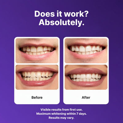 Purple Teeth Whitening Strips – Safe, Gentle & Peroxide-Free