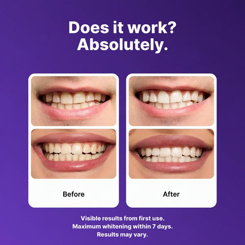 Purple Teeth Whitening Strips – Safe, Gentle & Peroxide-Free